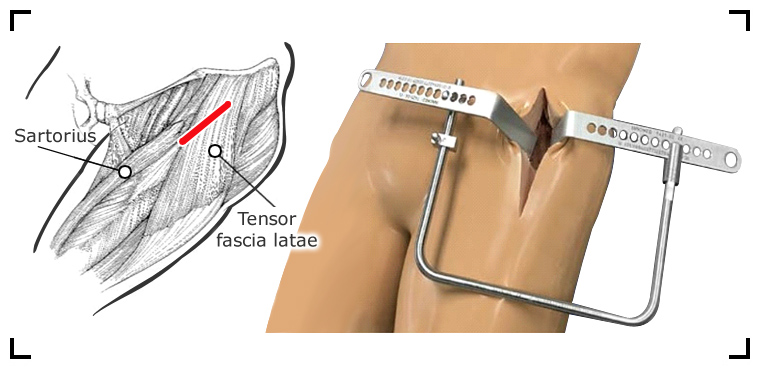 prothese-de-hanche-une-chirurgie-mini-invasive-par-mini-incision