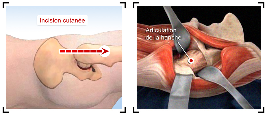 prothese-hanche-incision-voie-d-abord-anterieure-de-hueter