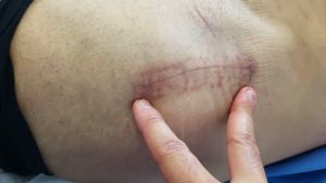 Cicatrice prothèse totale de hanche par voie antérieure mini-invasive.
