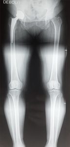 radiographie-paris-prothese-totale-de-hanche-debout